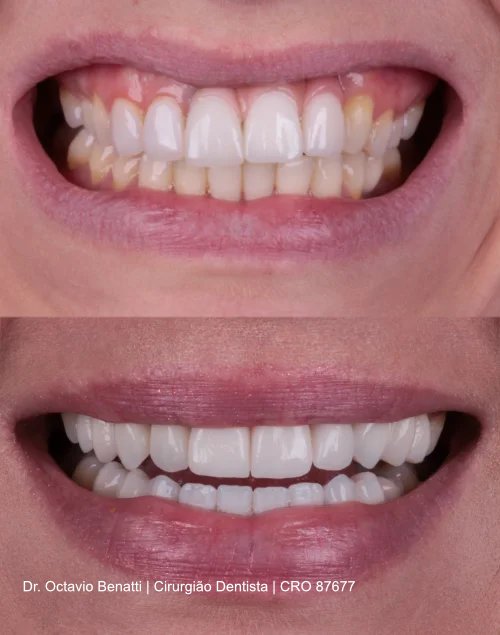 antes-depois1-1
